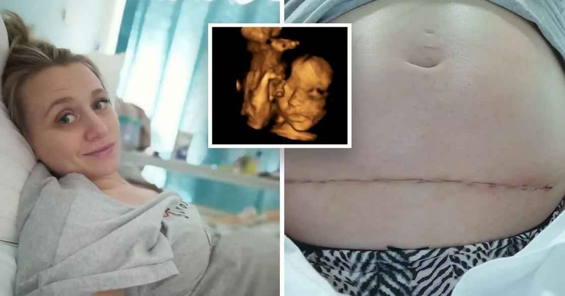 Неродено бебе извадено от уробата за операция и върнато обратно